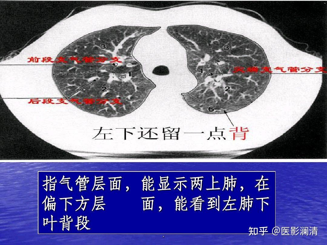 肺部五叶十八段在ct上怎么具体划分呢mimics做三维重建的话以什么标准