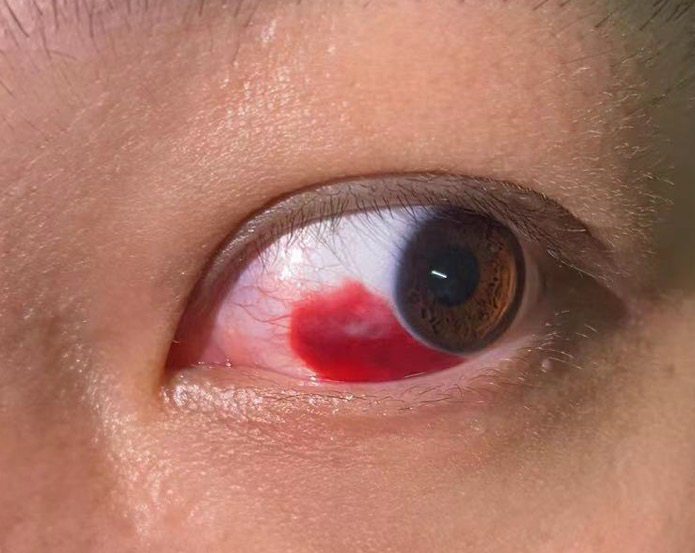 记录左眼结膜出血
