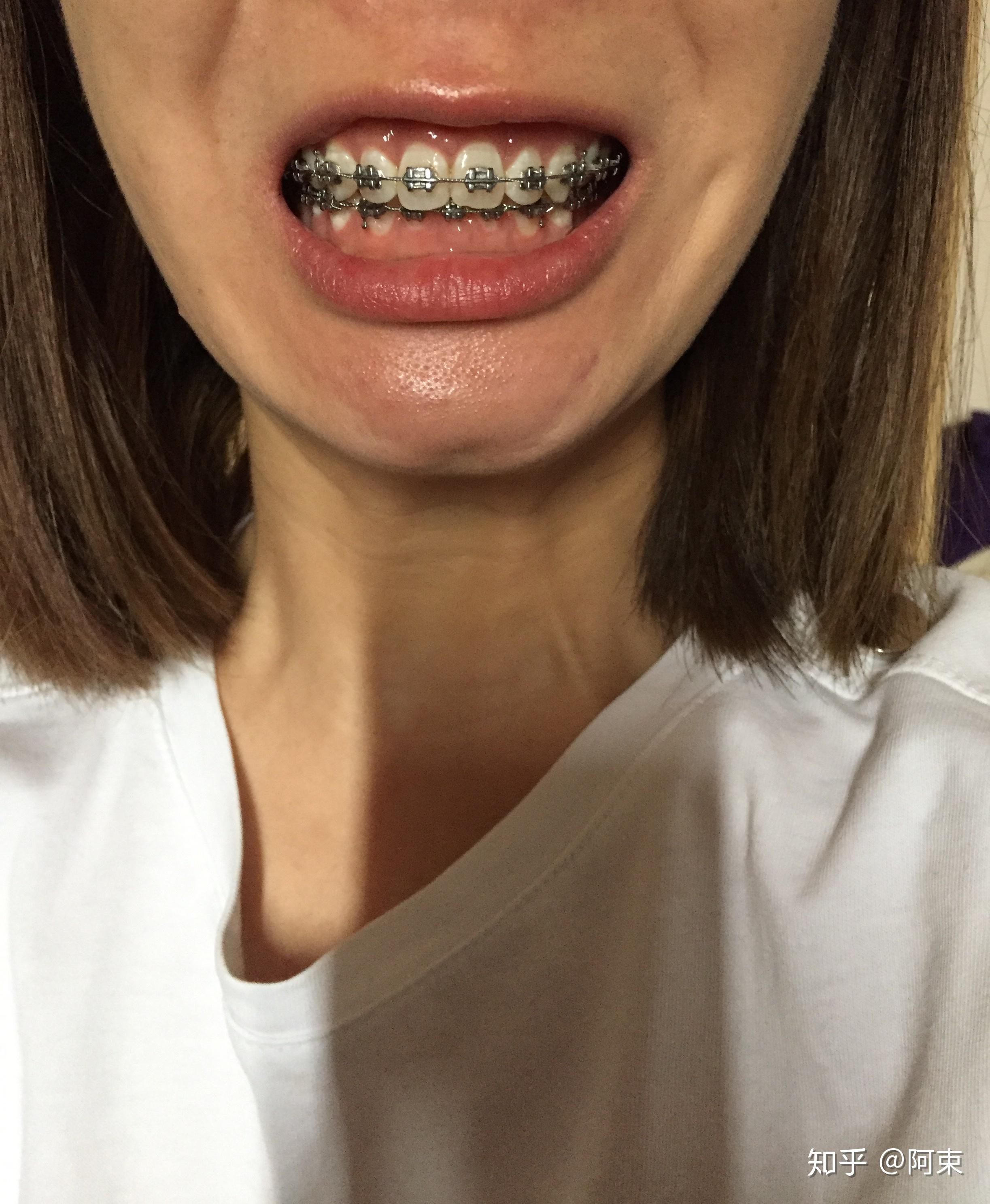 箍牙日记深覆合牙齿矫正