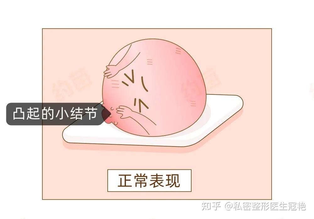 乳晕有这些表现可能是乳腺癌