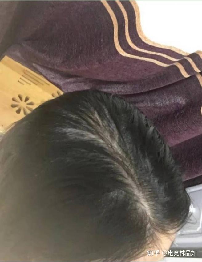 每天都大量掉头发怎么回事