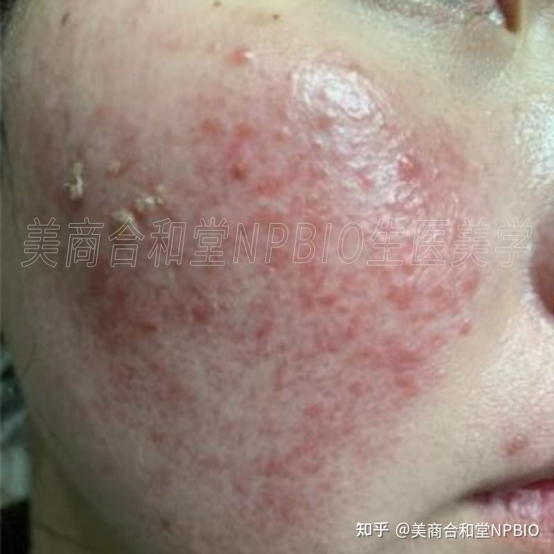 重度皮肤屏障受损合并激素性皮炎