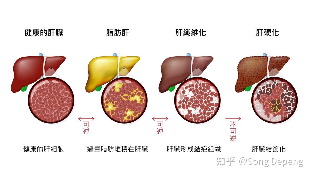 如果置之不理,可能進展為重度脂肪肝,引起肝臟發炎,繼而出現肝纖維化