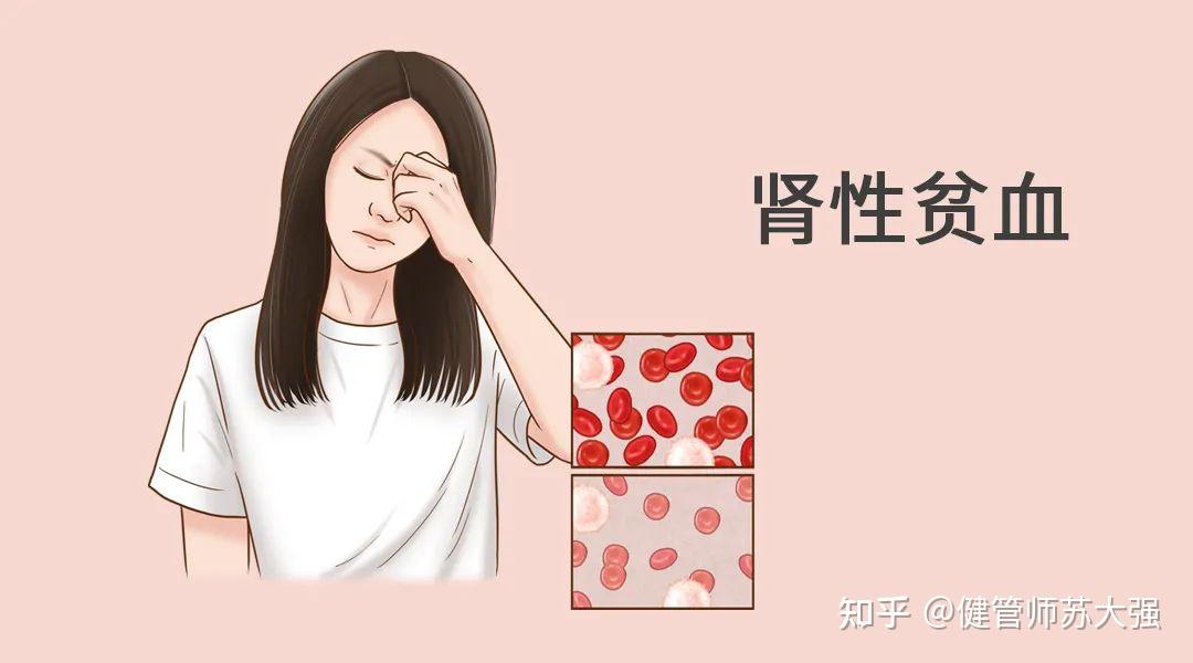 肾性贫血是慢性肾病患者常见的并发症,其发生率随着慢性肾脏病的进展