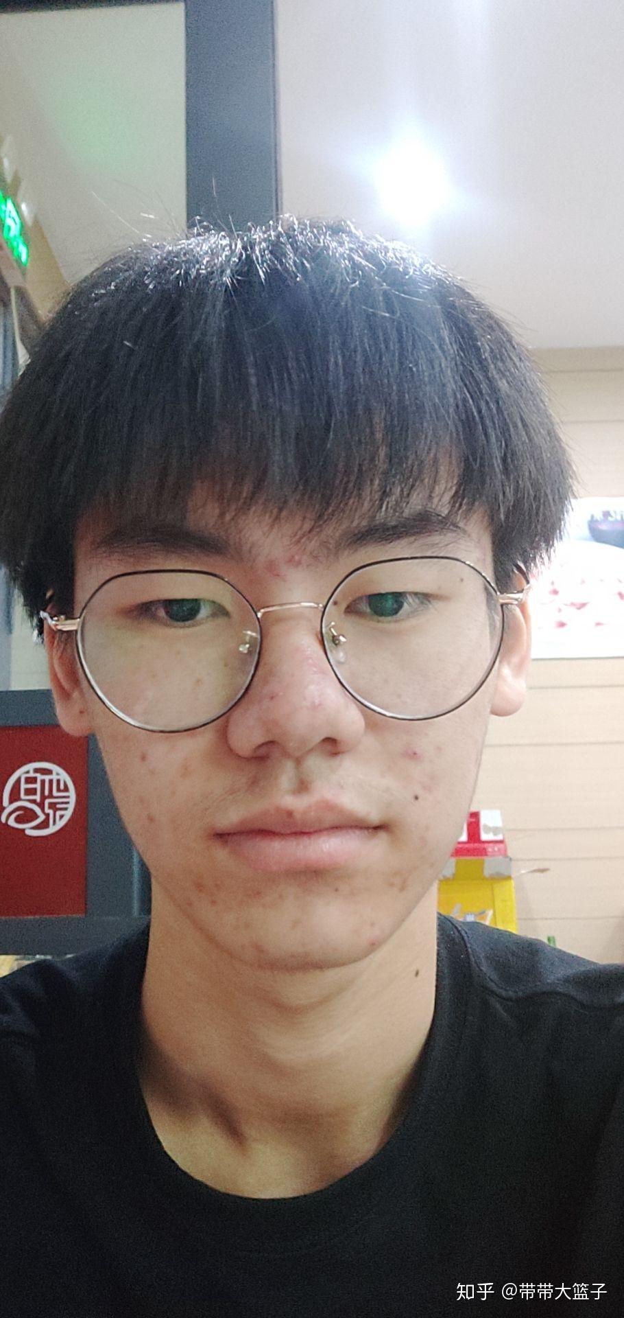 一个183五官帅的男生长了一脸痘痘痘印是什么体验? - 知乎