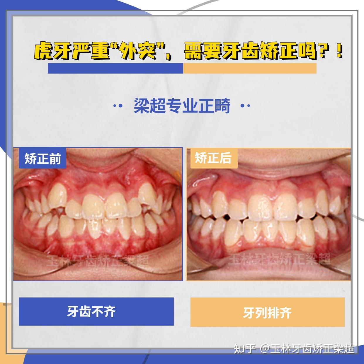 虎牙突出+牙齿拥挤不齐+个别牙反颌矫正案例 - 知乎