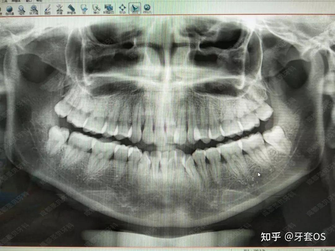 整牙別走彎路成都牙科醫生告訴你選擇一位靠譜的正畸醫生有多重要