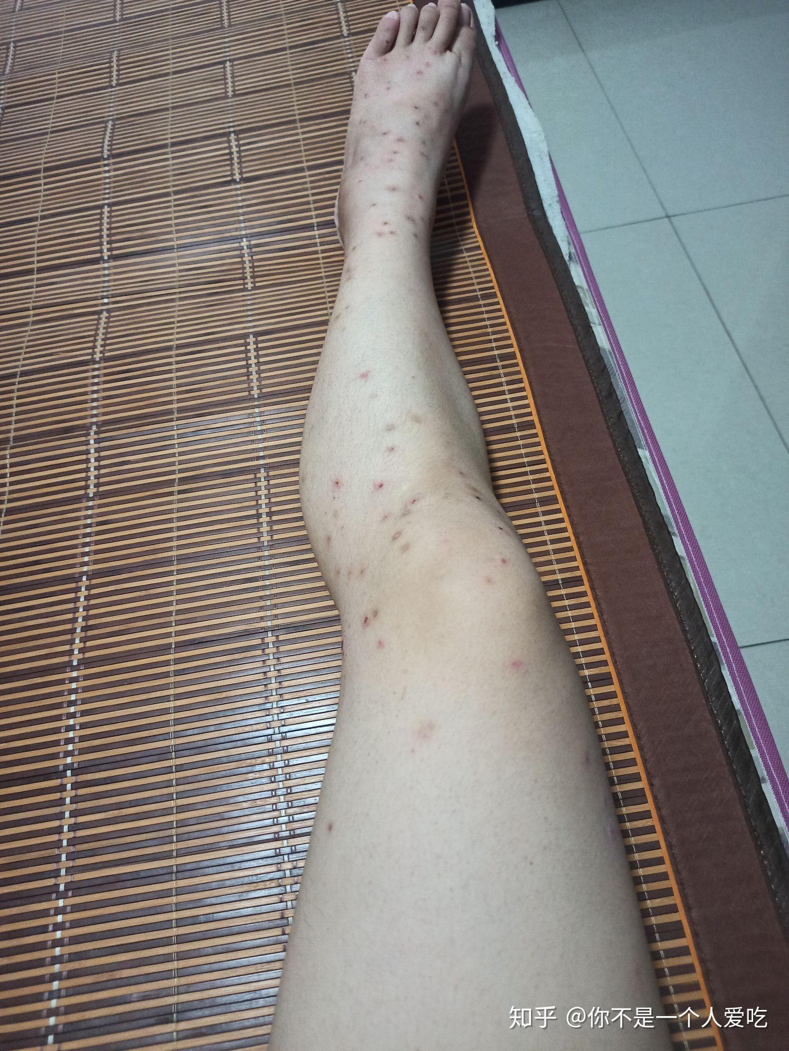 被飞蠓咬了很长时间没好去了医院也没有很好的效果有没有好的解决方法