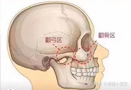 磨骨手術分兩個位置,顴骨顴弓,下頜角既然要講後遺症,就要先了解這個