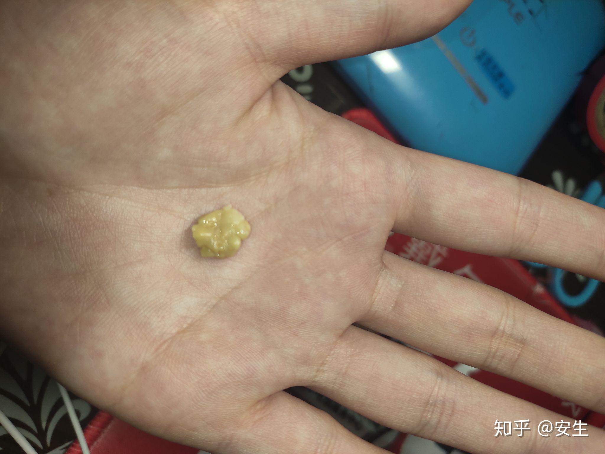 你见过最大的扁桃体结石有多大? - 知乎