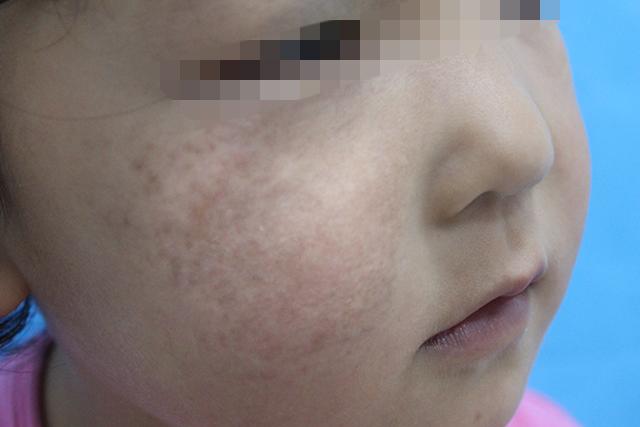 为什么会长胎记雀斑样痣是胎记吗