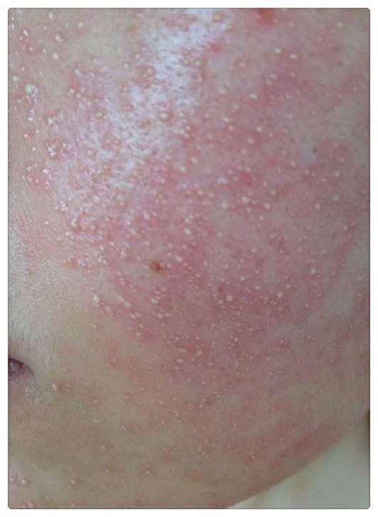 激素脸反复起逆光疹子为什么总是不下去