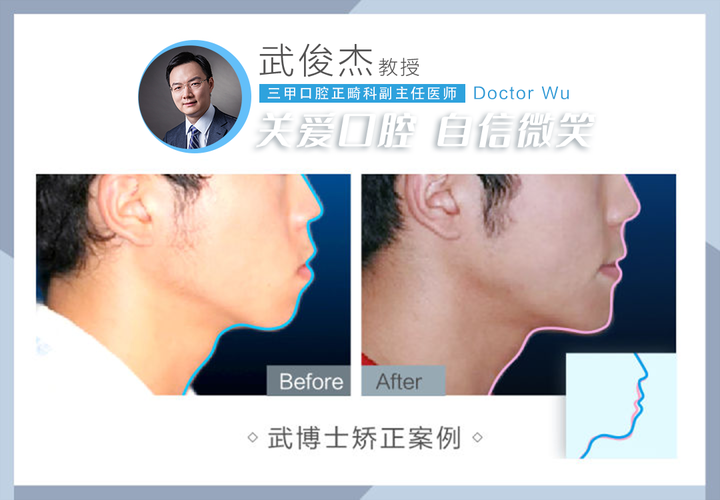 【开合+牙列拥挤】拔牙矫治案例 - 知乎