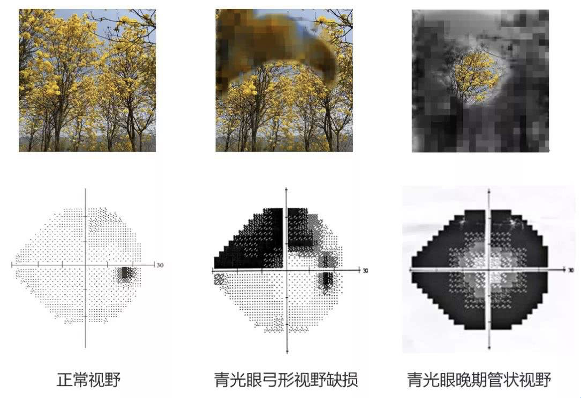 青光眼早期典型视野图图片