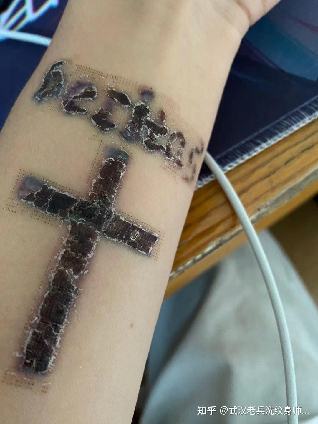 皮秒洗纹身恢复第1天12天效果