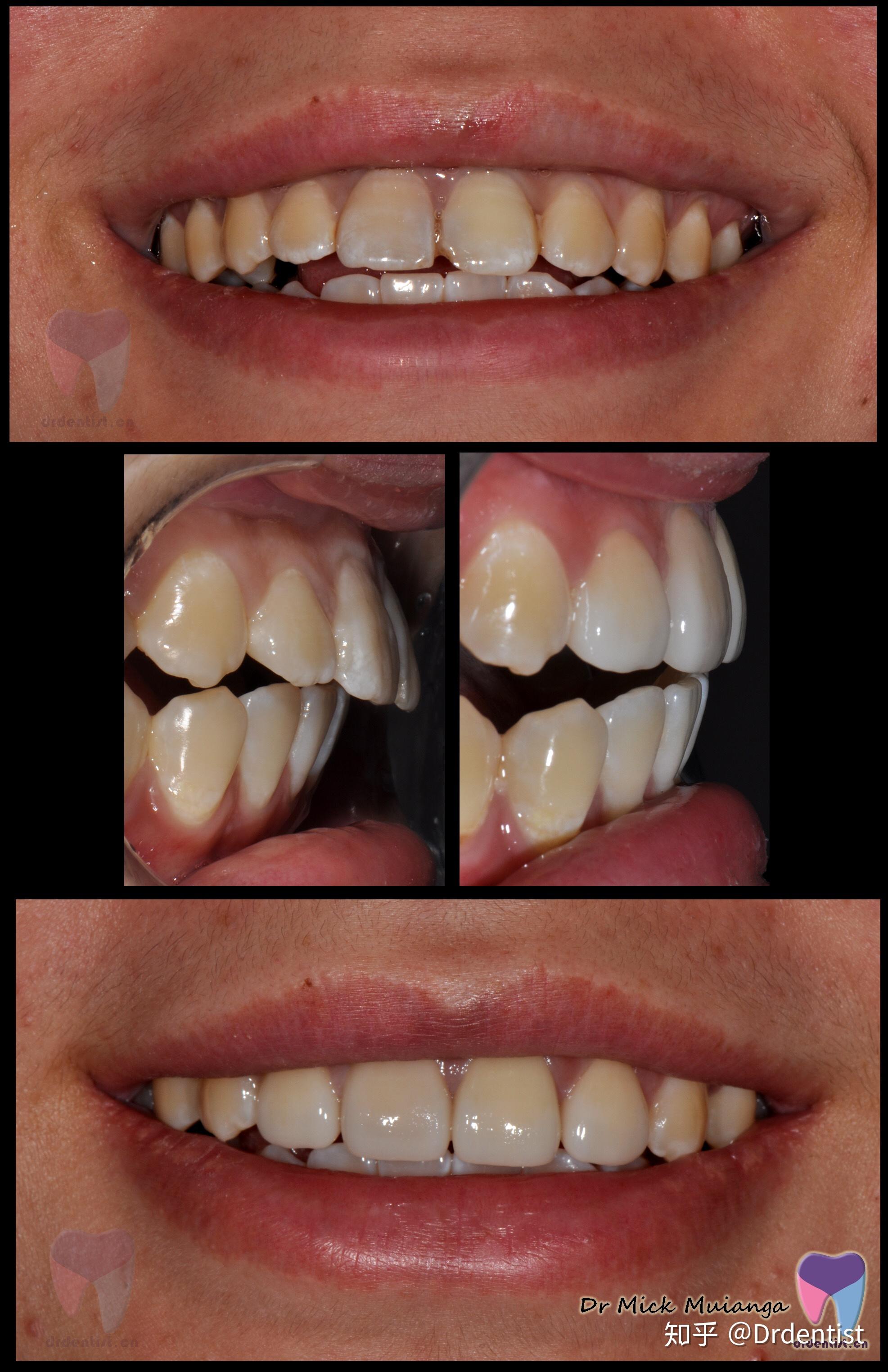 戴过牙套(矫正牙齿)的人脸型变了吗? - 知乎