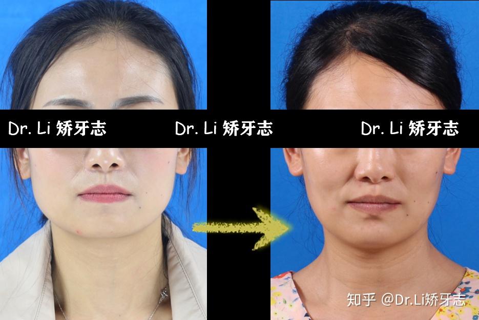 脸本来就是方形的就有点像牙套脸带牙套以后会不会更丑啊那种牙套脸