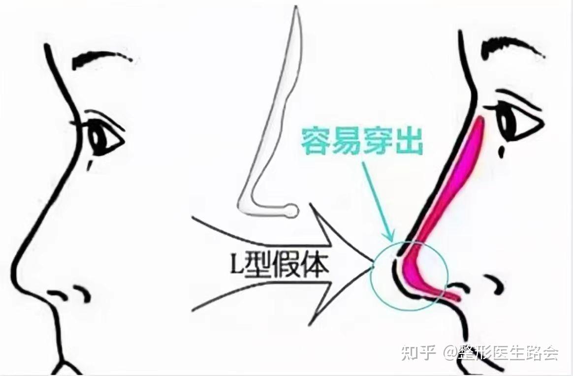 耳软骨隆鼻会假体穿透吗?