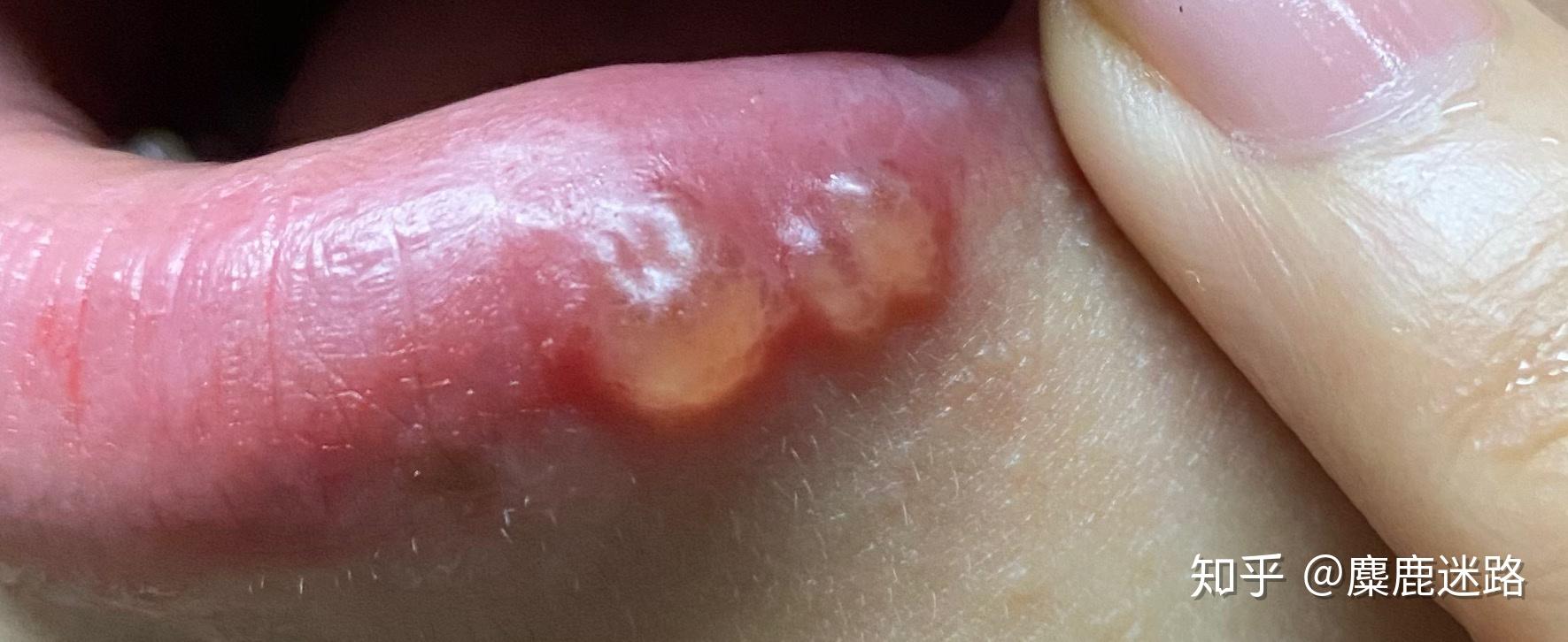 这是口唇疱疹吗?我在小学的时候好像得过一次?