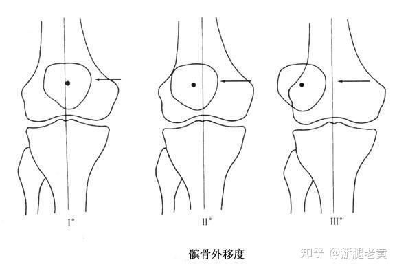 这三个症状出现要警惕髌骨软化！医生教你5招正确应对