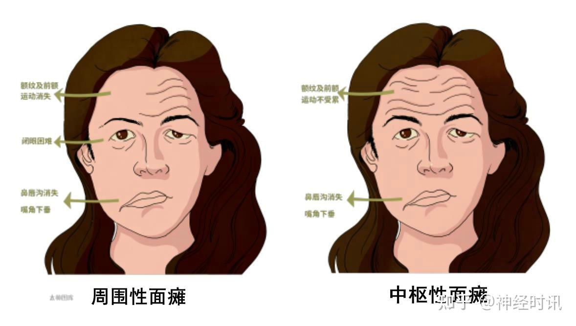 周围性面瘫的病因和治疗 — 知识分享 - 知乎