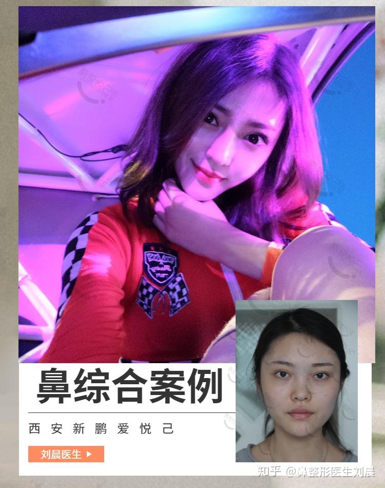 达拉斯综合隆鼻恢复期_达拉斯隆鼻和鼻综合_达拉斯隆鼻过程