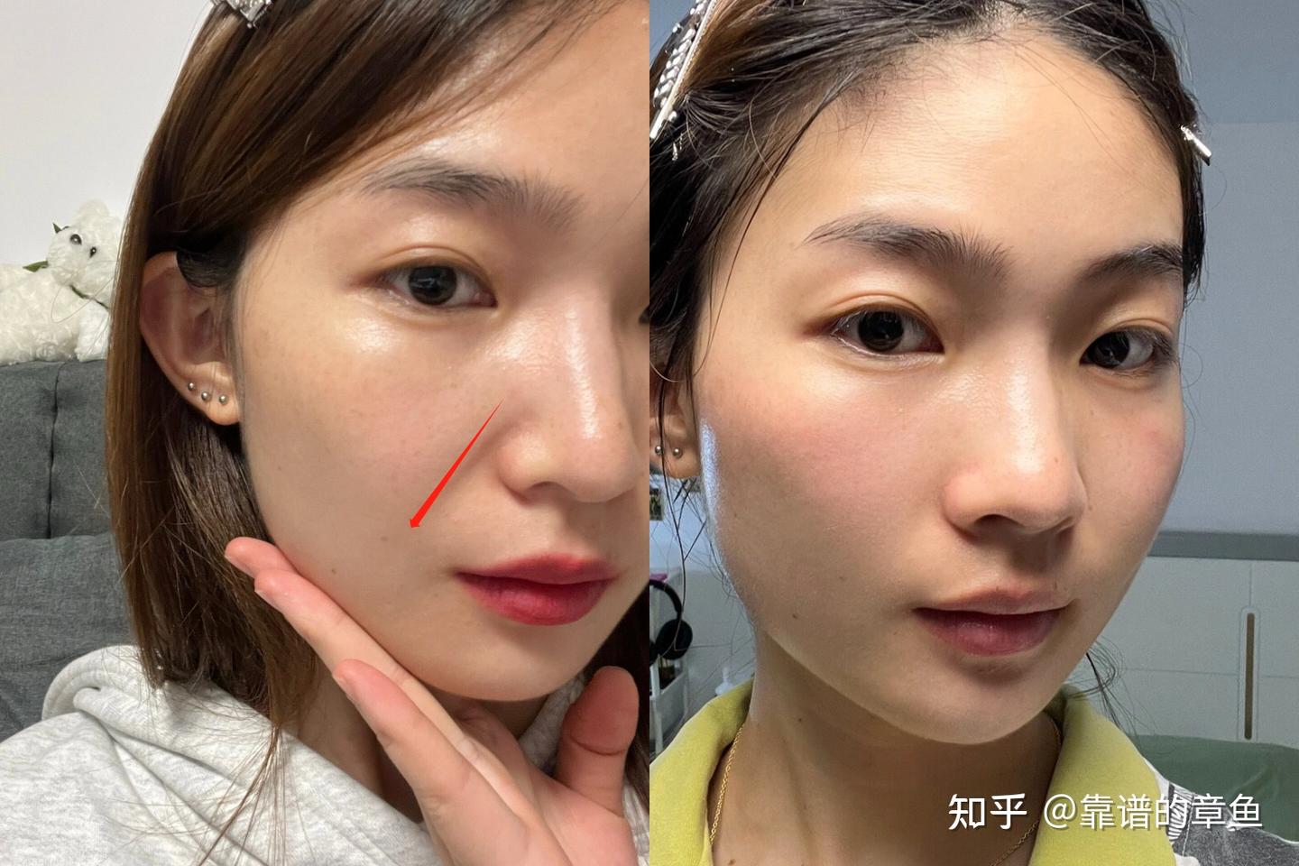 从医学角度讲,不做医美,如何低成本消除法令纹抬头纹? - 知乎