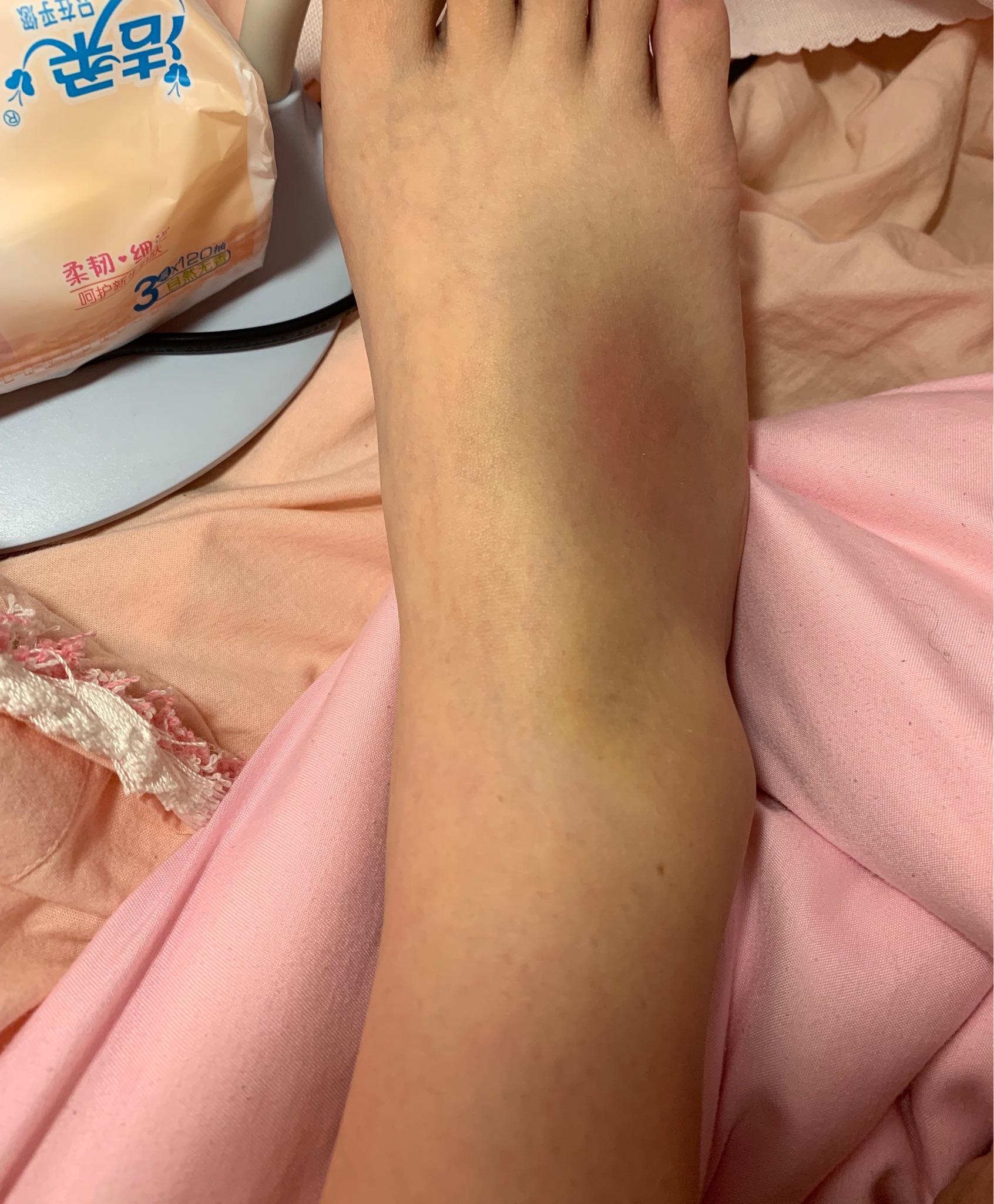 崴脚了一周不见好要怎么办