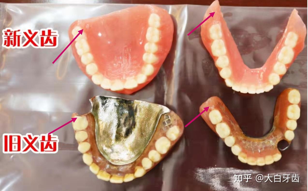 BPS吸附性义齿制作过程图片