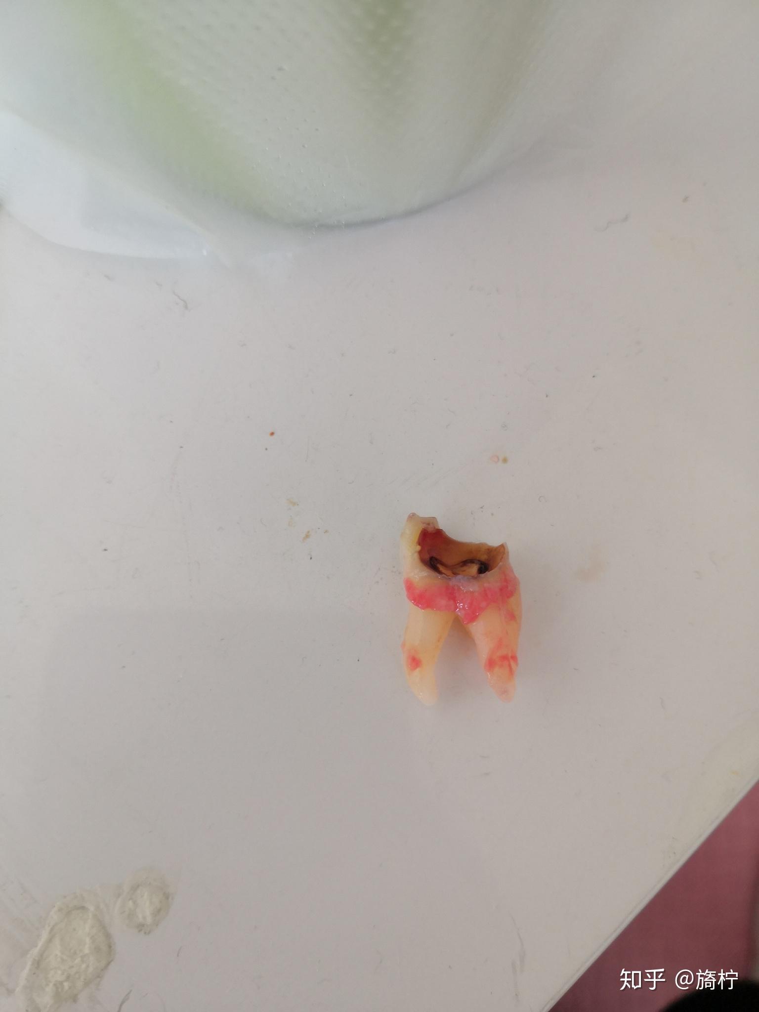 后牙残根延期种植和即刻种植对比-刘平的博客-KQ88口腔博客