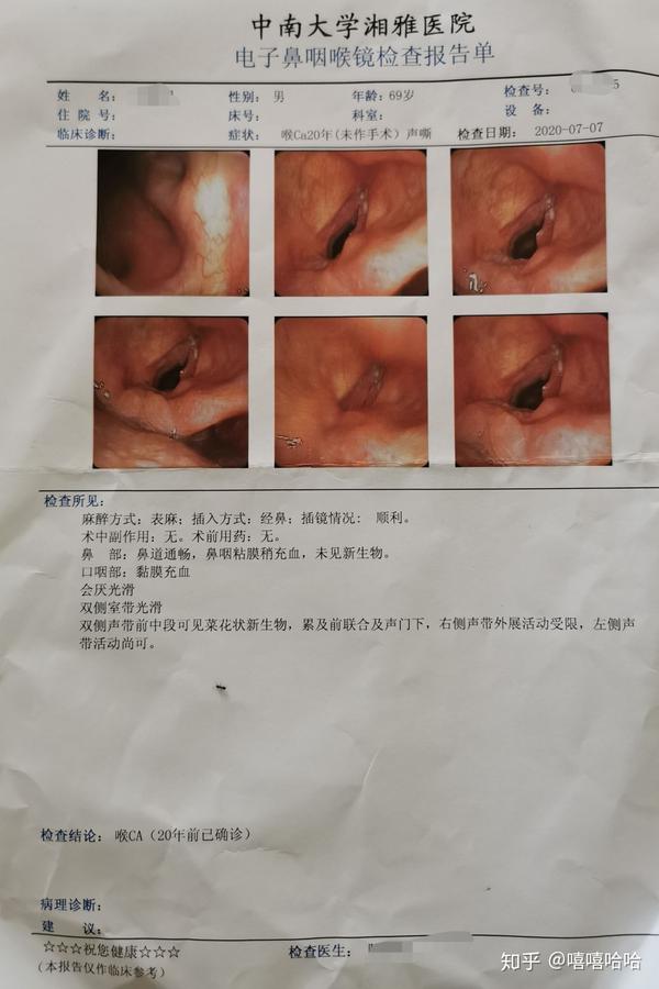 喉癌的喉镜报告图片图片