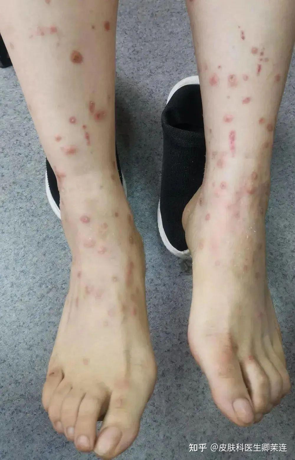 我:这个考虑可能是虫咬皮炎,也叫丘疹性荨麻疹.