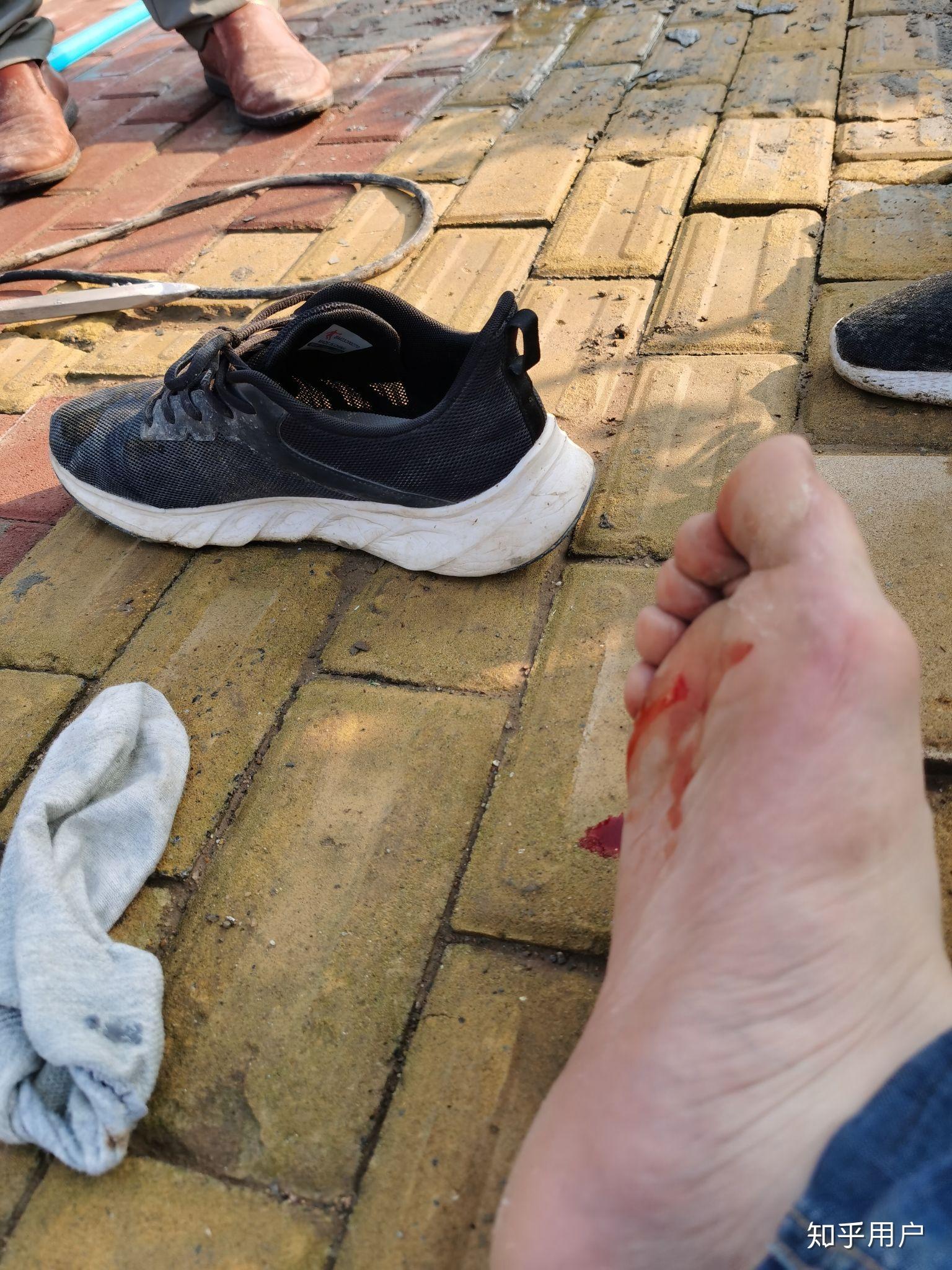 白血病治疗中的清创有多难受