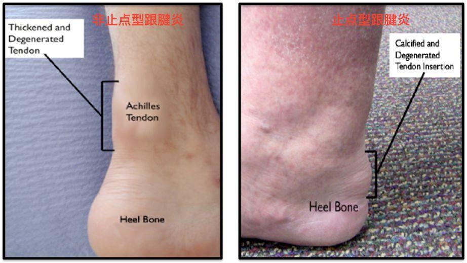 易建联刘翔都因此退赛我终于明白跟腱对一个跑者有多重要