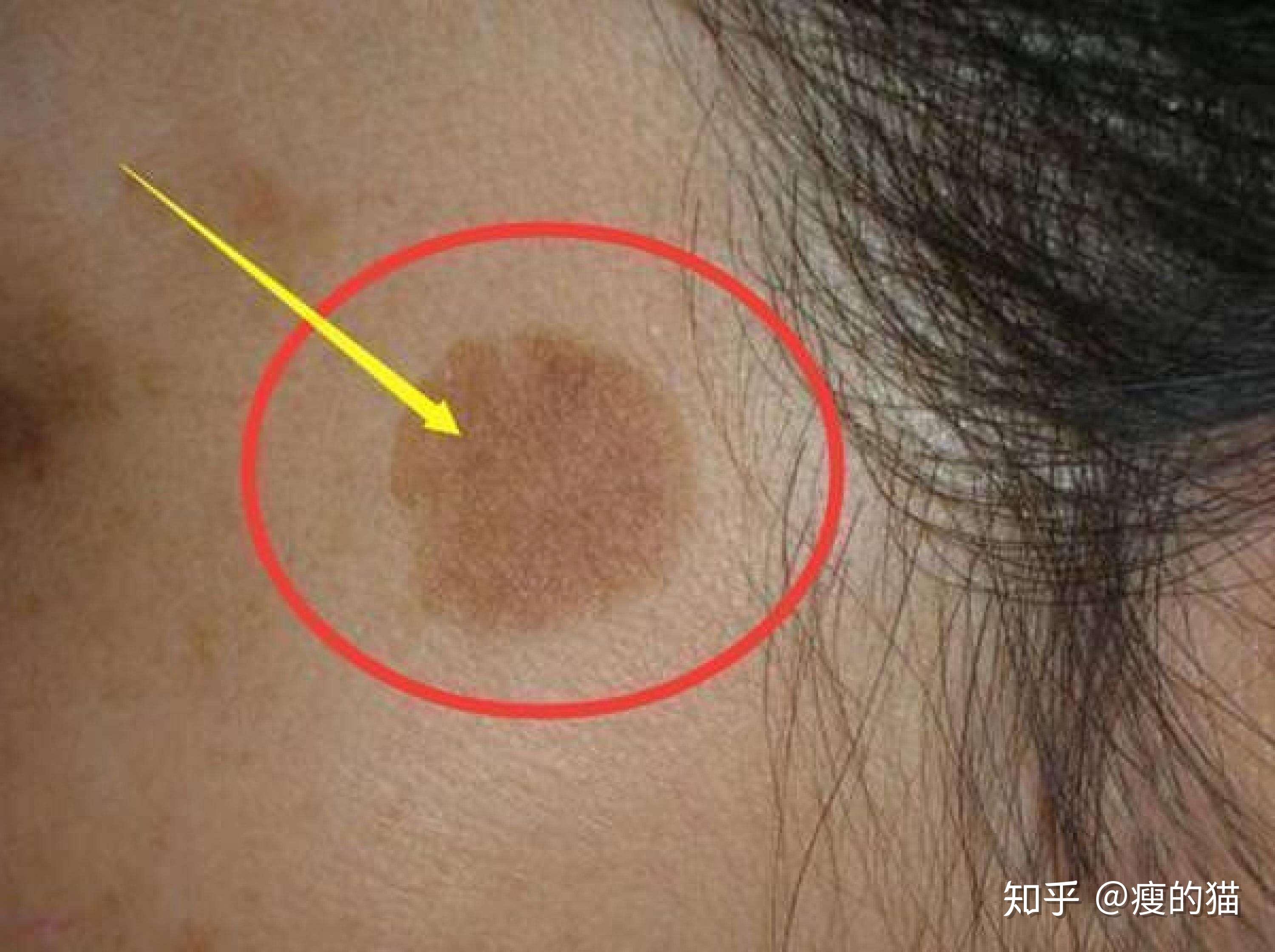 想祛斑不知道怎么选择机构