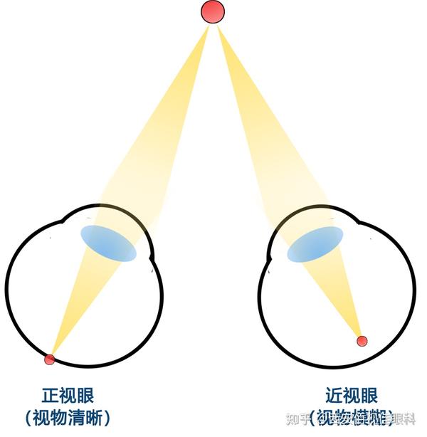 双眼相差300度,可以做近视手术吗? - 知乎