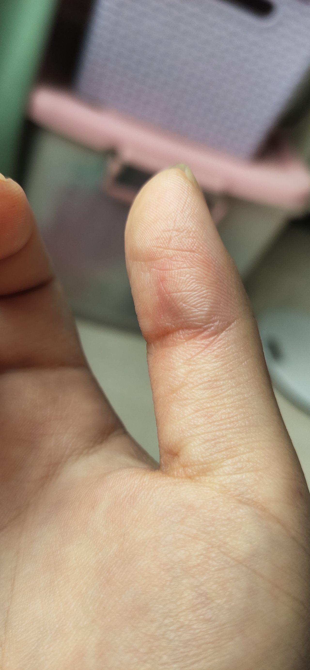 手指被油烫了怎么办? - 知乎