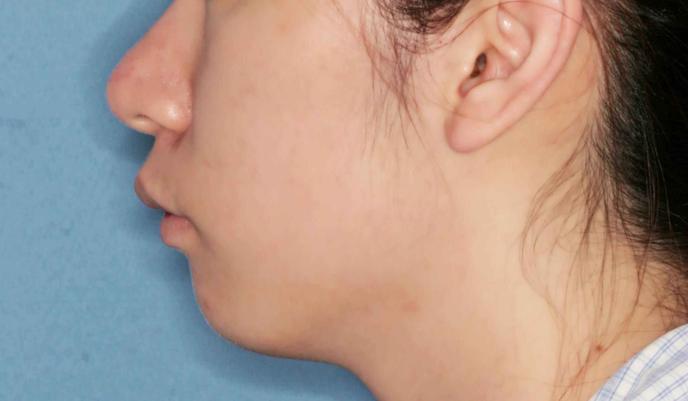 颌面手术如何做到精致无痕