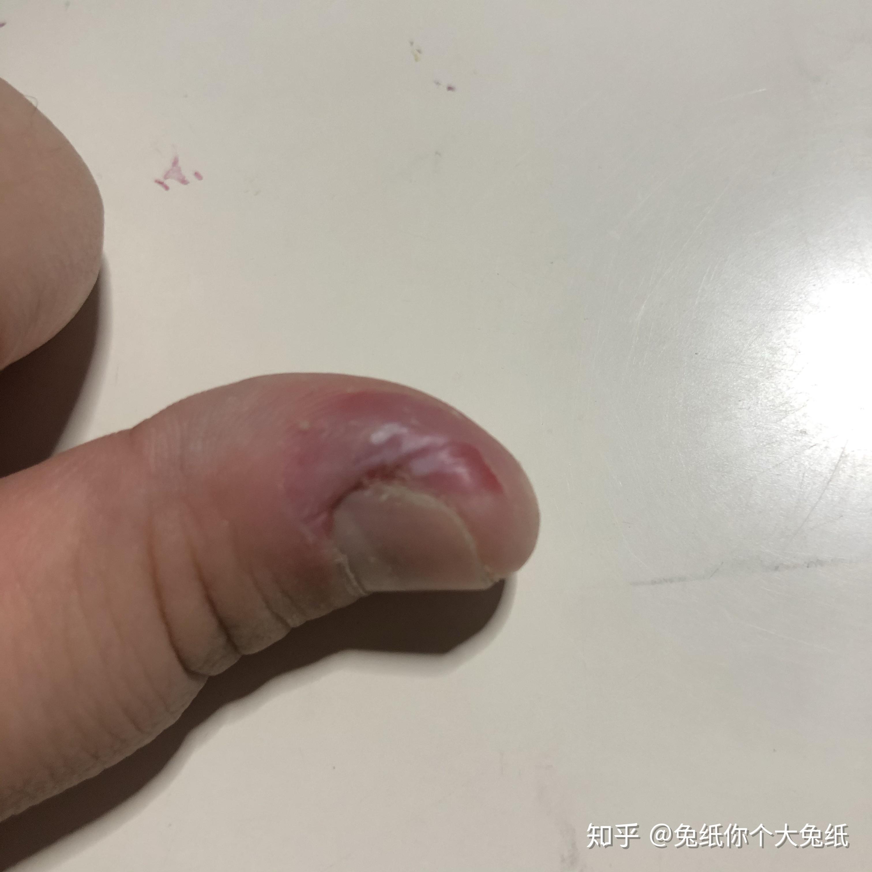 抠手指,撕肉刺,尤其是撕扯指甲边边的硬肉,特别喜欢那种疼痛的感觉是