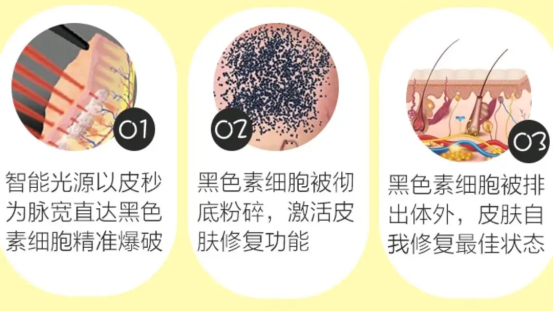 (一)祛斑原理1,皮秒祛斑通过蜂巢透镜技术,针对特定的色素斑点,将其