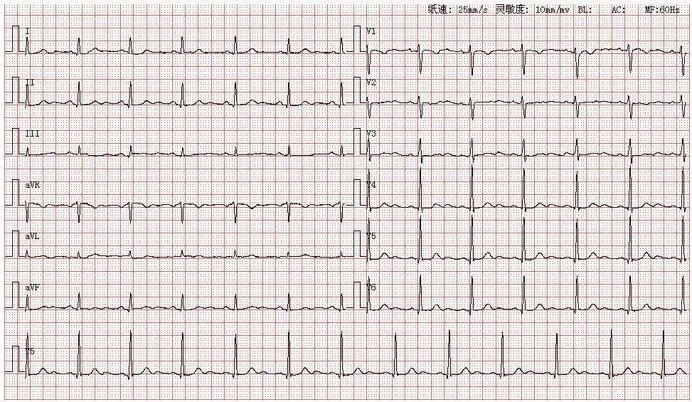心电图u波明显图片
