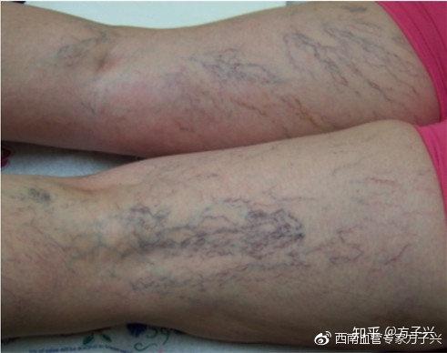 下肢静脉曲张早期症状有哪些 知乎