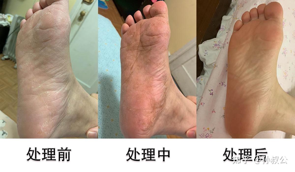 女生脚臭怎么办啊,有点害羞? 