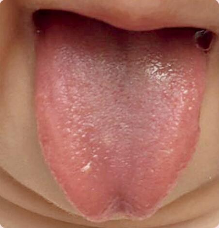 小孩舌苔正常图片图片