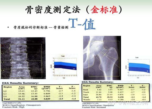 一圖讀懂骨密度檢測的t值發佈於 2020-06-15 10:04寫下你的評論.