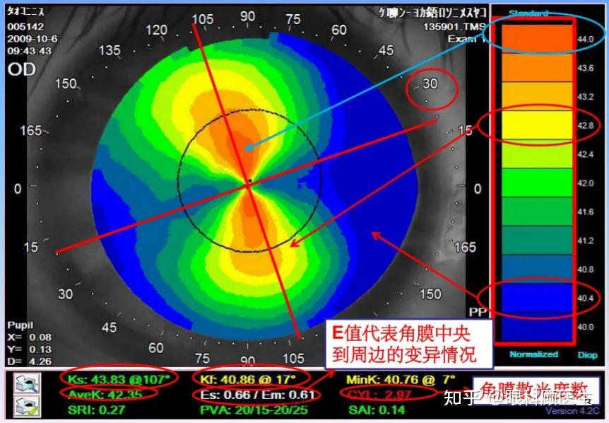 角膜地形图ks和kf图片