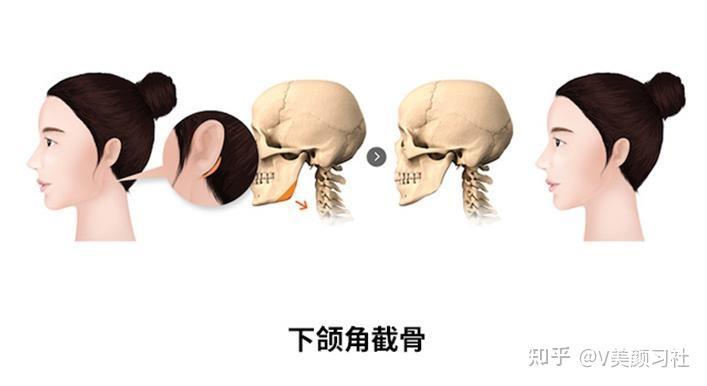 頜面科普影響下頜角手術效果的因素