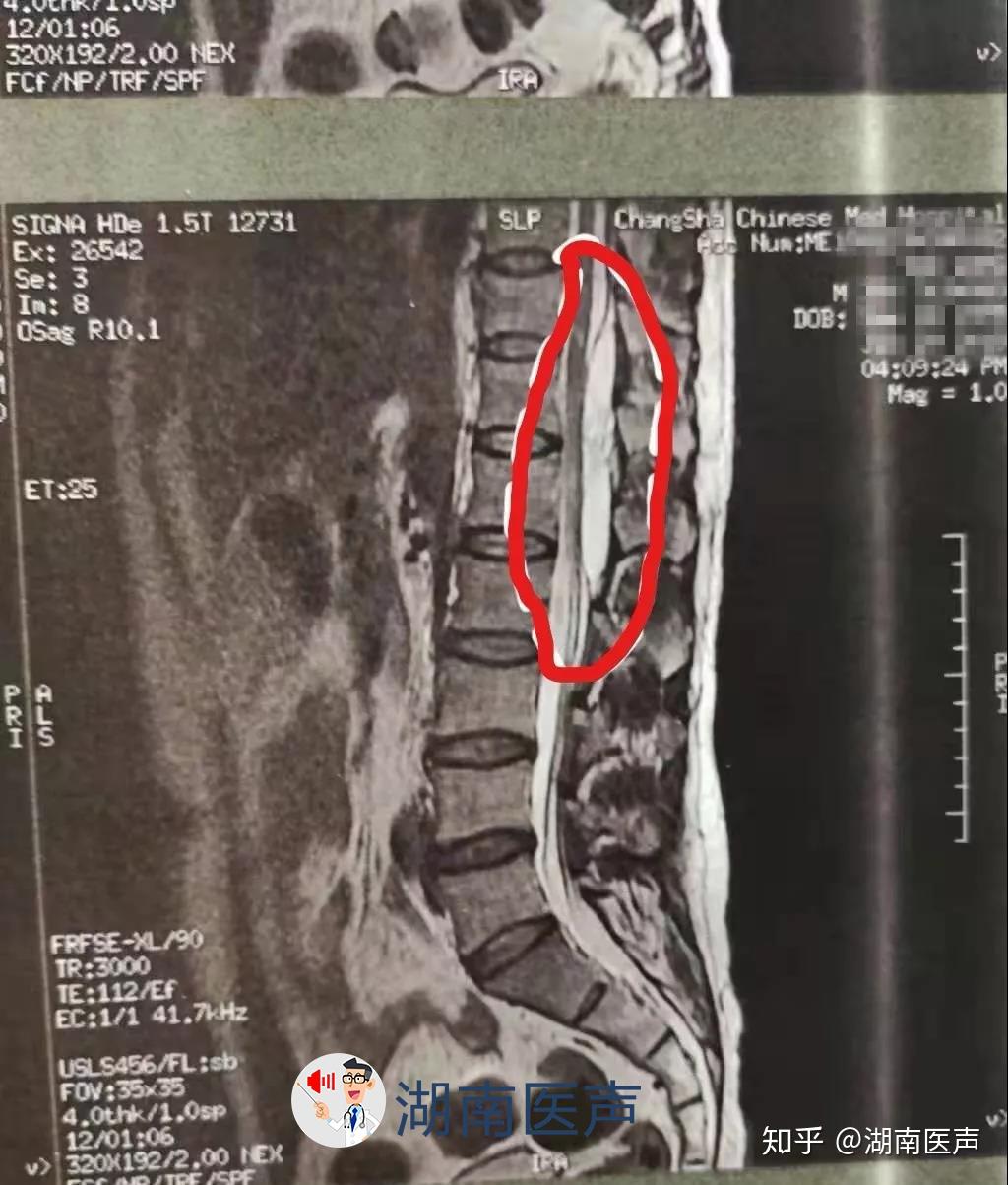 踝背伸肌力0級,核磁共振結果提示:姚先生的胸11椎至腰2椎椎管內,有一