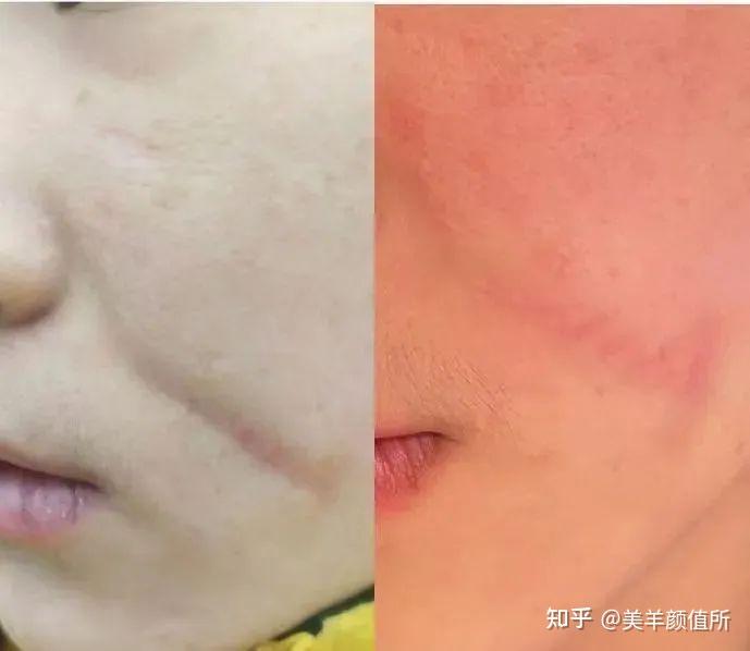 治疗凹陷疤痕推荐? - 知乎