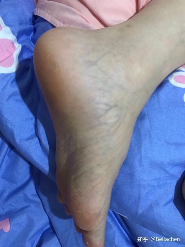我妈妈化疗完当天双脚肿了起来 并且脚面上血管非常明显 请问下什么原因 知乎